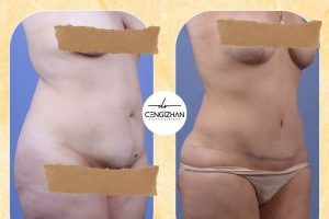 Karın germeye hangi korseyle başlanır? - Kapak Görseli